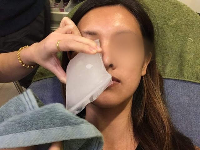 チェンマイほくろ除去