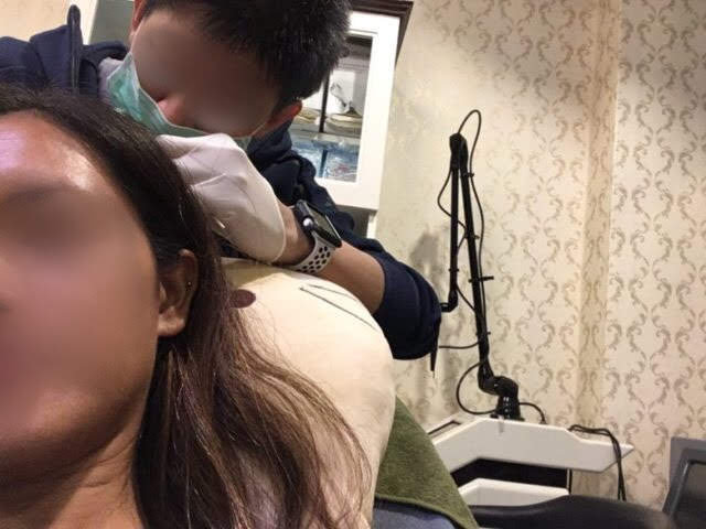 チェンマイほくろ除去