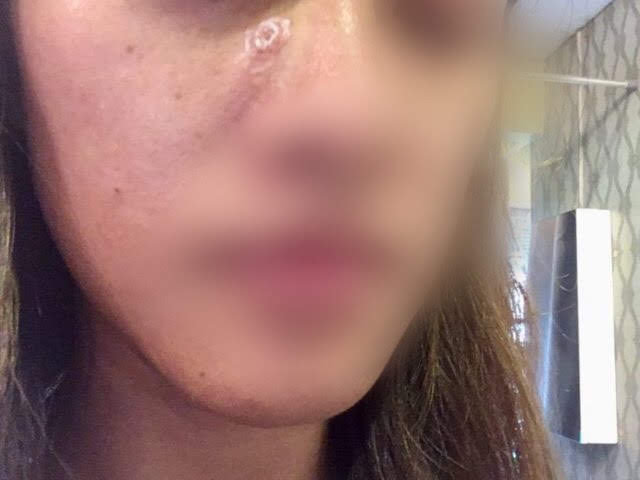 チェンマイほくろ除去